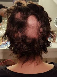 alopecia-areata-belovelywigs3